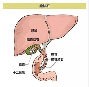 冬季胆结石“凶猛” 小石头危害大！